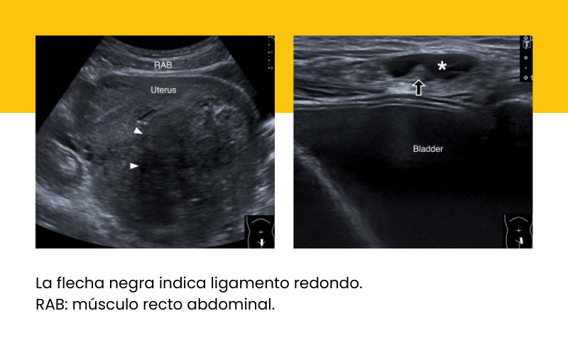 9. Hernia inguinal indirecta ecografia tempo formacion.png